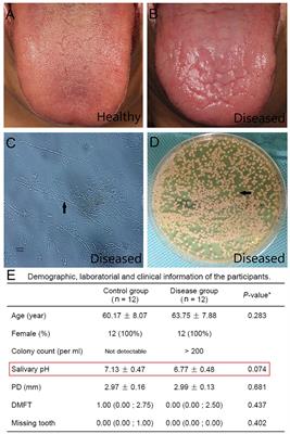 Oral Microbiota Composition and Function Changes During Chronic Erythematous Candidiasis